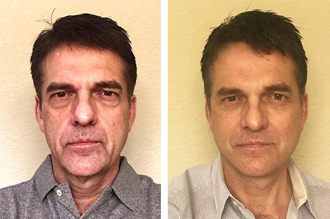 Featured image of post Plastic Surgery Before And After Men