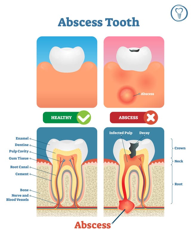Featured image of post Stages Abscess Tooth Swollen Face Pictures